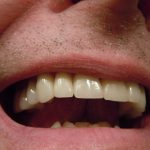 Czy wybielanie zębów jest trwałe?