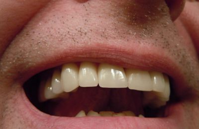Czy wybielanie zębów jest trwałe?